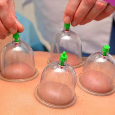 Cupping therapy