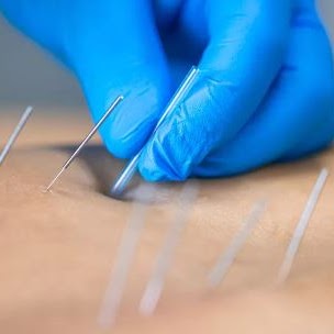 Dry needling